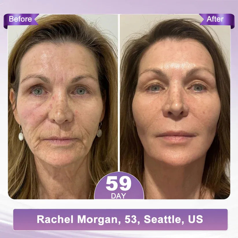 𝑶𝒇𝒇𝒊𝒄𝒊𝒂𝒍 𝑺𝒕𝒐𝒓𝒆| 𝐋𝐚𝐝𝐲𝐬𝐜𝐚𝐫𝐭® 𝐏𝐃𝐑𝐍 𝐌𝐮𝐥𝐭𝐢-𝐏𝐞𝐩𝐭𝐢𝐝𝐞 𝐌𝐚𝐬𝐬𝐚𝐠𝐢𝐧𝐠 𝐁𝐨𝐝𝐲 𝐑𝐨𝐥𝐥𝐞𝐫 𝐂𝐫𝐞𝐚𝐦-Anti-aging, Hydrating, Skin Firming & Lifting, Skin Repair, Even Tone, Acne and Dark Spot Treatment, Wart and Mole Removal, and Psoriasis Relief
