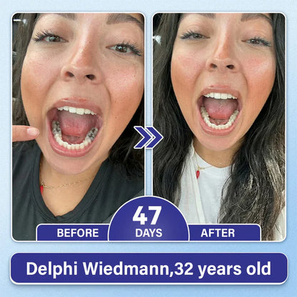 Ladyscart Tooth & Gum Repair Fast-Dissolving Microneedle Patch✨ (𝟓-𝐢𝐧-𝟏 💎 𝐑𝐞𝐛𝐮𝐢𝐥𝐝 𝐄𝐧𝐚𝐦𝐞𝐥 & 𝐃𝐞𝐧𝐭𝐢𝐧 • 𝐒𝐭𝐫𝐞𝐧𝐠𝐭𝐡𝐞𝐧 𝐆𝐮𝐦𝐬 • 𝐄𝐫𝐚𝐝𝐢𝐜𝐚𝐭𝐞 𝐓𝐚𝐫𝐭𝐚𝐫 & 𝐎𝐝𝐨𝐫 • 𝐖𝐡𝐢𝐭𝐞𝐧𝐢𝐧𝐠 • 𝐒𝐭𝐨𝐩 𝐓𝐨𝐨𝐭𝐡 𝐒𝐞𝐧𝐬𝐢𝐭𝐢𝐯𝐢𝐭𝐲)