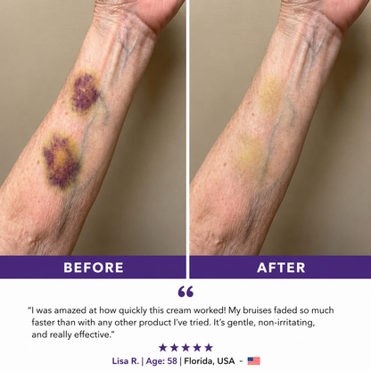 💥75K+ Sold💕 Ladyscart® Bruise Repair Cream | Soothe Bruises & Strengthen Fragile Skin