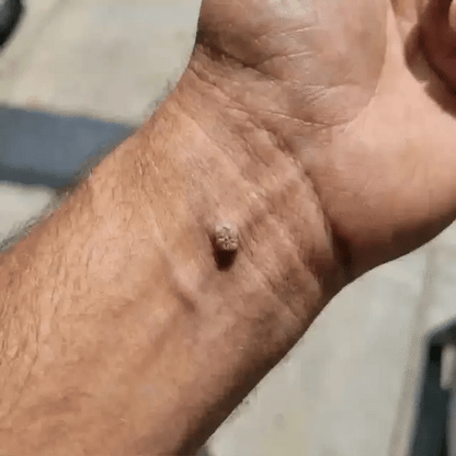 Soluble Microneedle Botanical Skin Tag Removal Patch