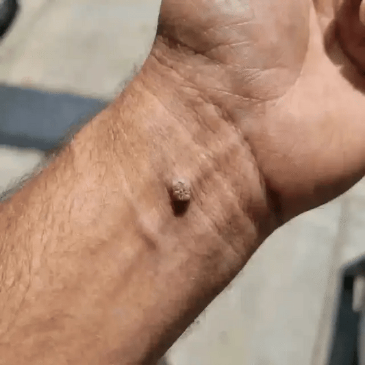 Soluble Microneedle Botanical Skin Tag Removal Patch