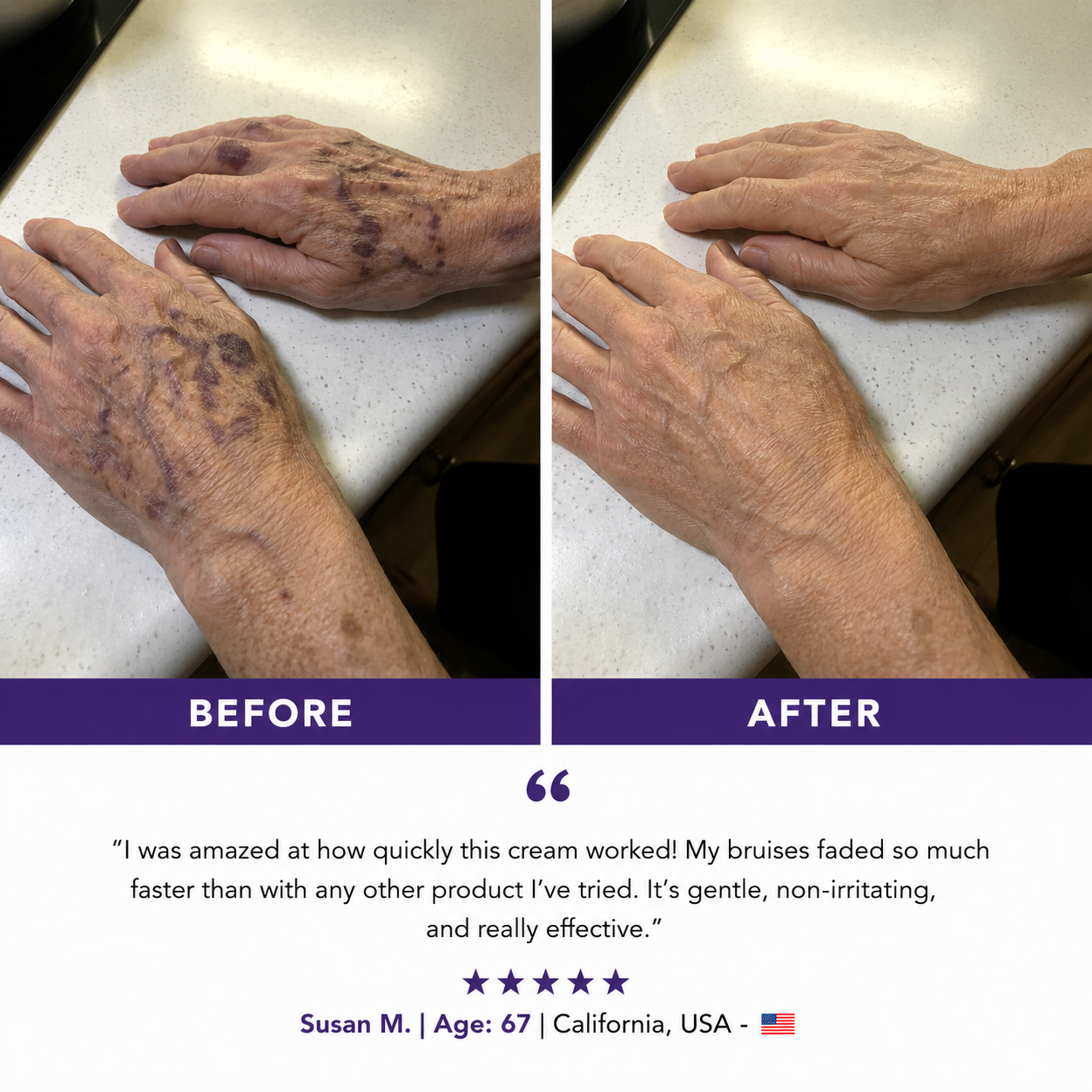 💥75K+ Sold💕 Ladyscart® Bruise Repair Cream | Soothe Bruises & Strengthen Fragile Skin