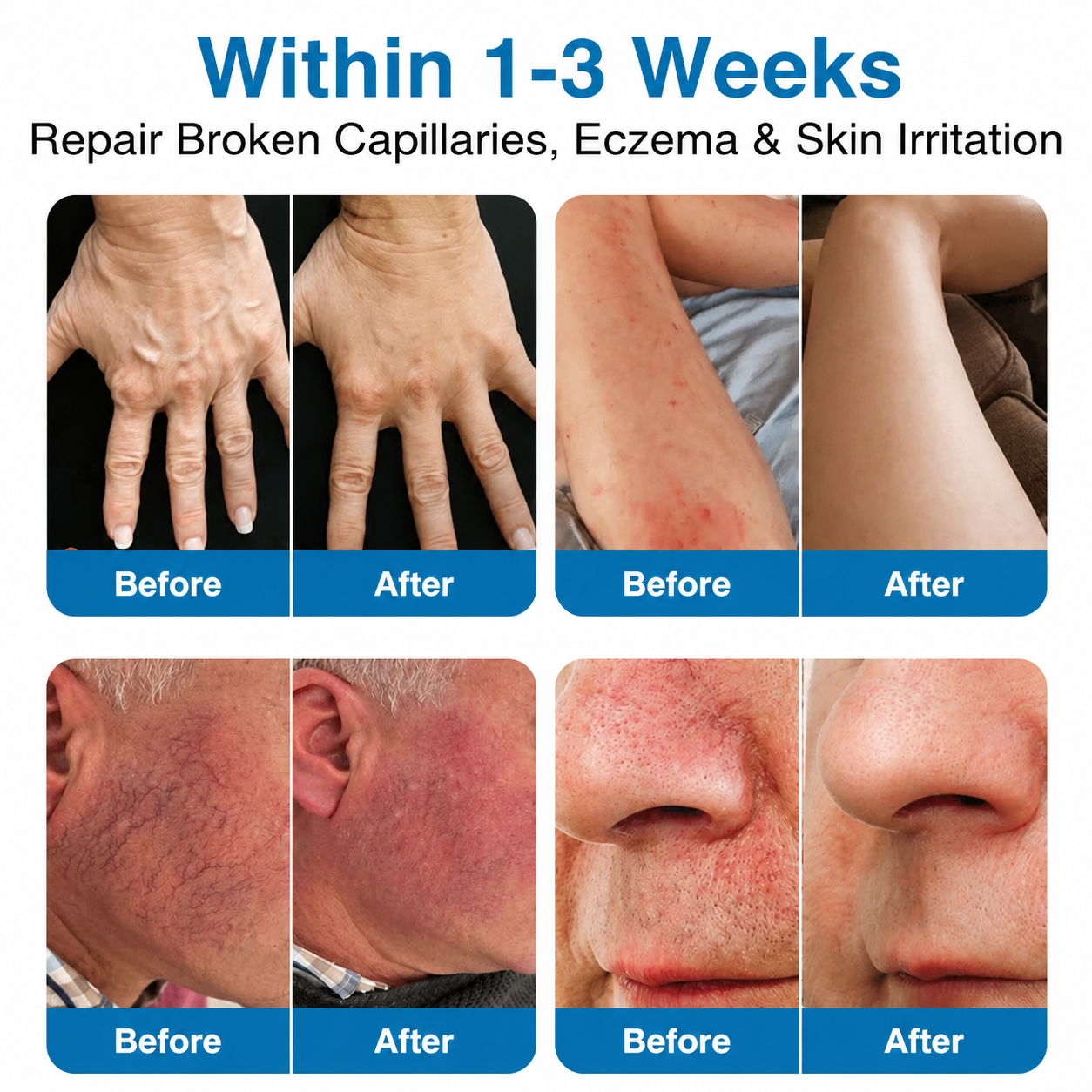 🇺🇸🥇🏆Ladyscart® VeinRepair Microneedle Patch Roll⚡Instant Relief, Long-Term Results