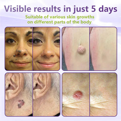 Soluble Microneedle Botanical Skin Tag Removal Patch