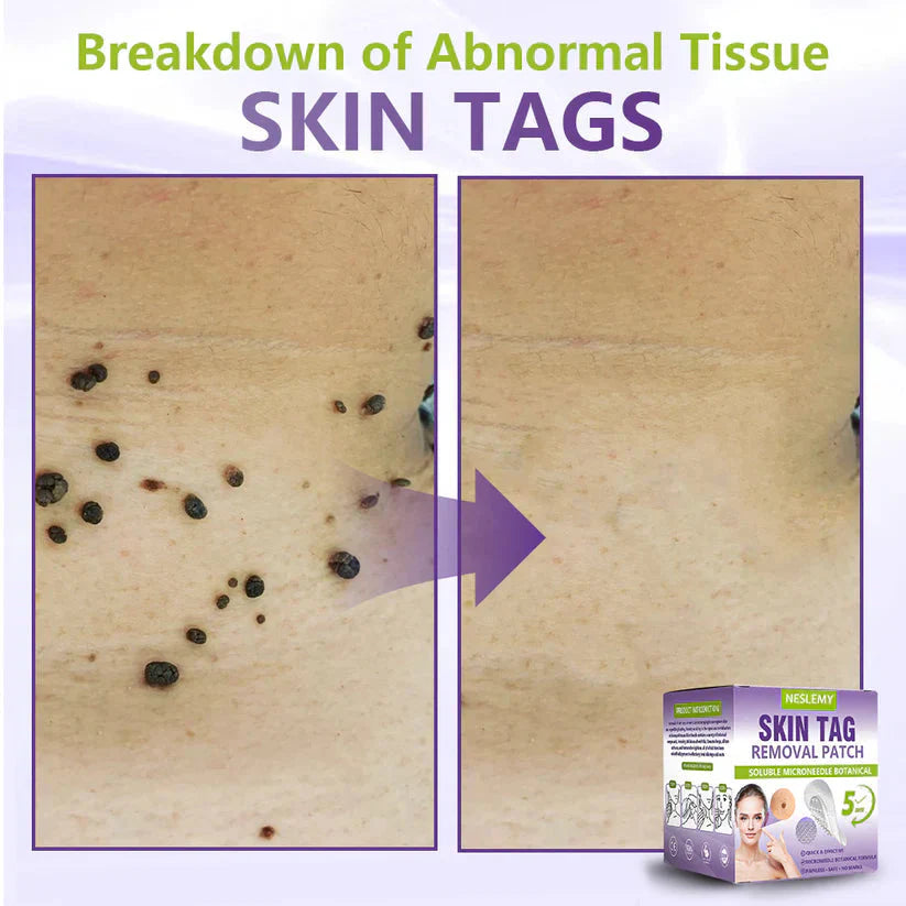Soluble Microneedle Botanical Skin Tag Removal Patch