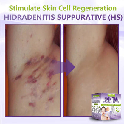 Soluble Microneedle Botanical Skin Tag Removal Patch