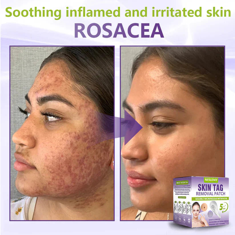Soluble Microneedle Botanical Skin Tag Removal Patch