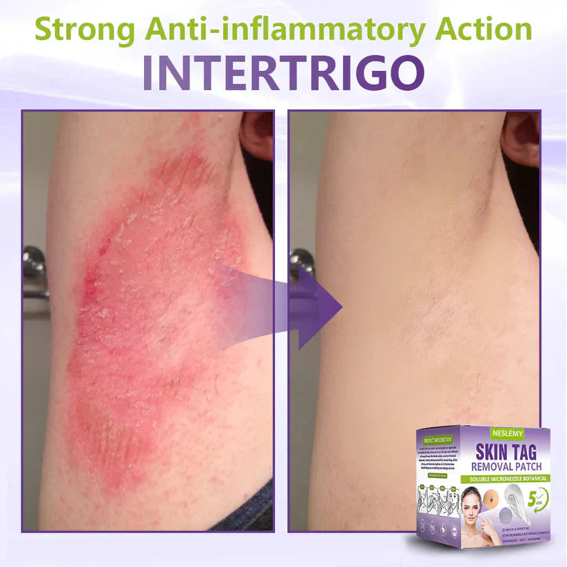 Soluble Microneedle Botanical Skin Tag Removal Patch