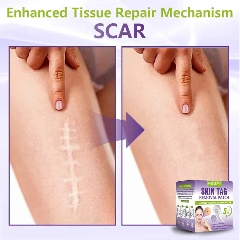 Soluble Microneedle Botanical Skin Tag Removal Patch