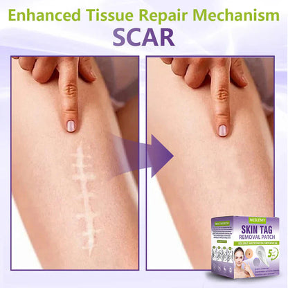 Soluble Microneedle Botanical Skin Tag Removal Patch