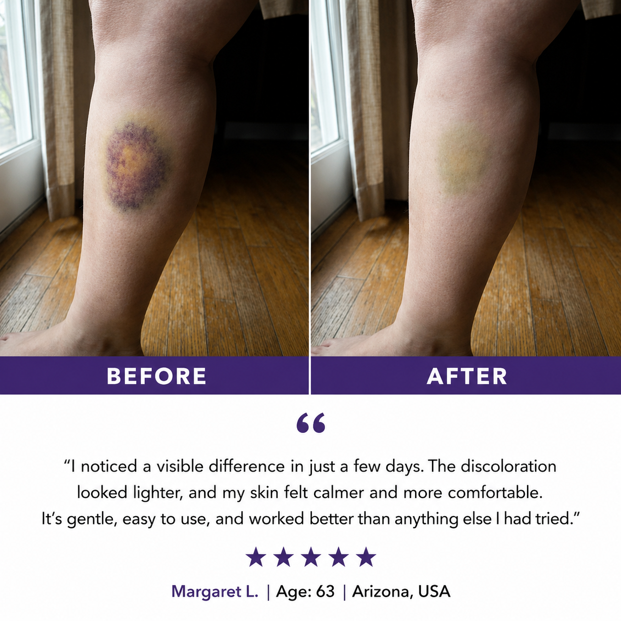 💥75K+ Sold💕 Ladyscart® Bruise Repair Cream | Soothe Bruises & Strengthen Fragile Skin