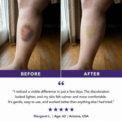 💥75K+ Sold💕 Ladyscart® Bruise Repair Cream | Soothe Bruises & Strengthen Fragile Skin